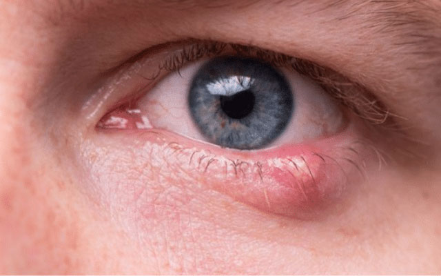 Lẹo mắt là một trong những dạng viêm nhiễm nang lông mi mắt